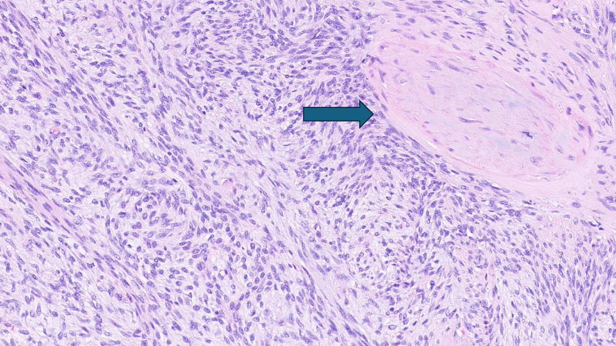 KyleDPerryMD's tweet photo. Dermatofibrosarcoma protuberans (particularly fibrosarcomatous DFSP) can occasionally be found to have a myoid type cell proliferation often associated with vessels (see arrows). #BSTPath, #UmichPath, #BSTpathGoBlue, #dermpath https://t.co/ja500TRDbP