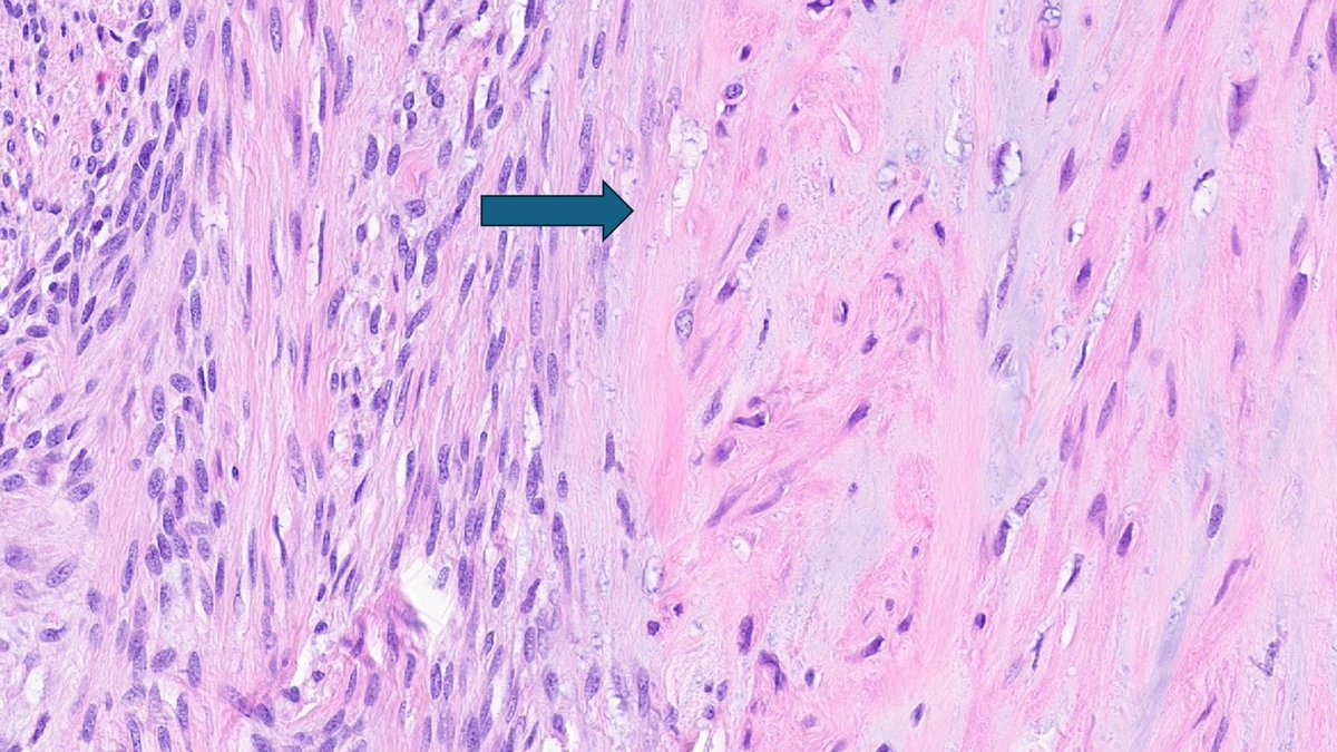 KyleDPerryMD's tweet photo. Dermatofibrosarcoma protuberans (particularly fibrosarcomatous DFSP) can occasionally be found to have a myoid type cell proliferation often associated with vessels (see arrows). #BSTPath, #UmichPath, #BSTpathGoBlue, #dermpath https://t.co/ja500TRDbP
