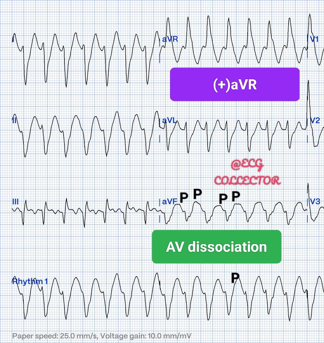 DrRazi4's tweet photo. Answer: VT

#ECG shows WCT with HR 170bpm:

VT signs:
1. AV dissociation
2. (+) aVR &amp; Extreme axis -155 degree
3. Brugada Sign
4. Josephson's sign
5. Atypical RBBB ��broad monophasic R wave

1. RBBB V1
2. r/S <1 V6
3. Discordant axis Lead 2/3

🔺APM VT
#Cardiology #CardioTwitter https://t.co/ETEeRxNVyI