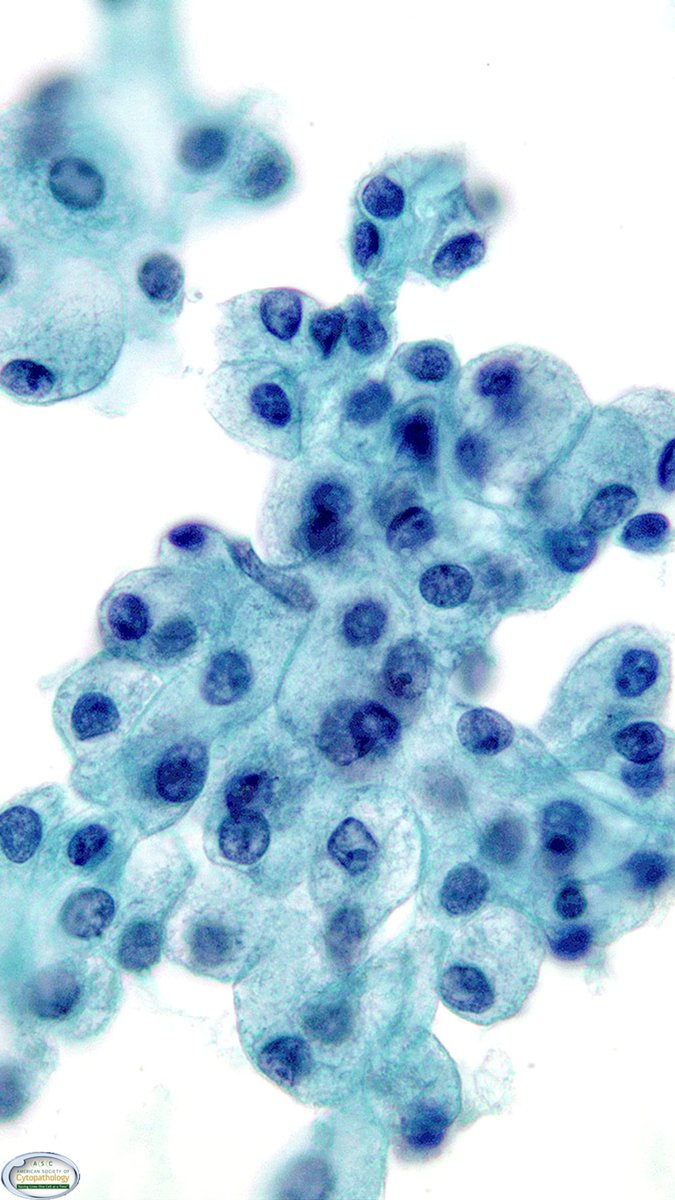 52F with a right-sided mass near the TMJ.
How would you interpret the FNA?
A) Non-Diagnostic
B) Neoplasm - Benign
C) Neoplasm - SUMP
D) Malignant
#CytoPath #GUPath #PathTwitter #pathology