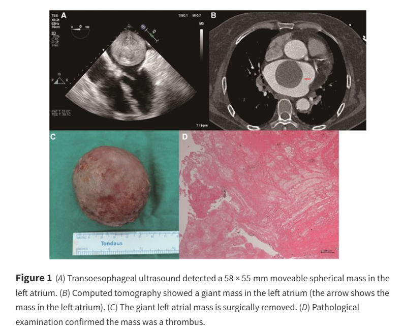 Giant left atrial thrombus in a patient with non-valvular atrial fibrillation ow.ly/V6QW50V3s4J

#EHJCaseReports <a href="/Phiso_de/">Philipp Sommer</a> <a href="/TJ_Yeo/">Tee Joo YEO</a> <a href="/aayshacader/">Aaysha Cader</a> <a href="/BoldiKovacsMD/">Boldizsar Kovacs</a> <a href="/KardiologieHH/">Erik Rafflenbeul</a> <a href="/ANazmiCalik/">A.Nazmi Calik</a> <a href="/O_Azizy_MD/">Obayda Azizy</a> <a href="/saramoscatelli7/">Sara Moscatelli</a> <a href="/EHJCREiC/">EHJCaseReports Editor-in-Chief</a> #CardioX