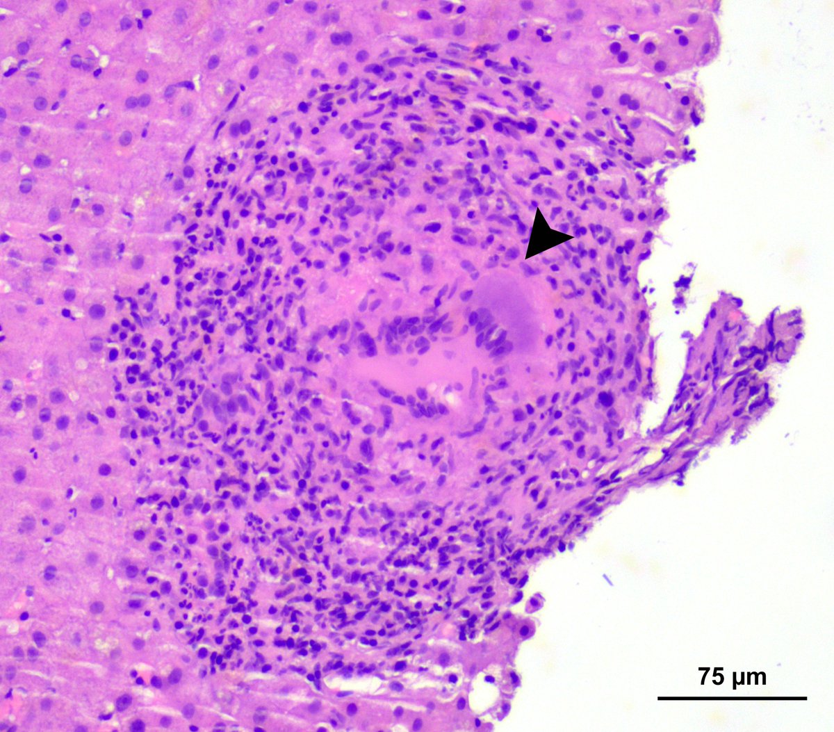 ESP_Pathology's tweet photo. 🔬 Hepatic epithelioid granuloma with a multinucleated   giant cell (🔼black arrowhead) in BCG-induced granulomatous hepatitis. 

💉A rare complication of BCG therapy!  

Dr Alessandro Gambella, Pathologist &amp; ESP Alumni, Italy. 
#EveryDayPathology #pathology #PathTwitter https://t.co/6xcw2XEH1v