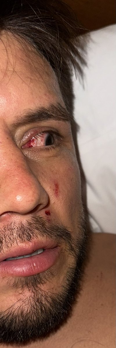 Diplopia, Soft Tissue Damage, Corneal Abrasion.

“hE wANteD a wAy OuT” #UFCSeattle