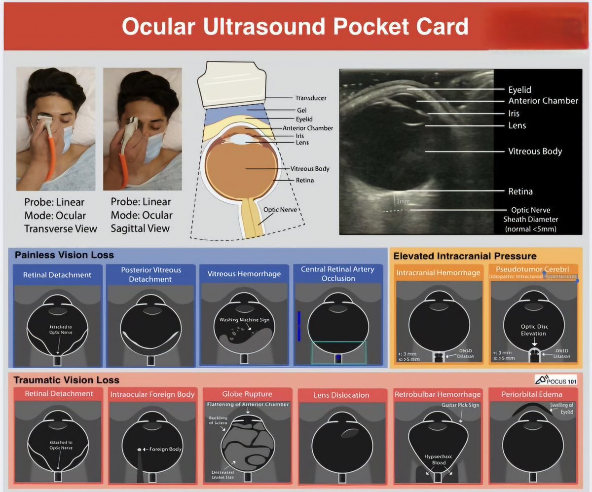 Ocular Ultrasound Pocket Card
#ultrasound
#sonologist