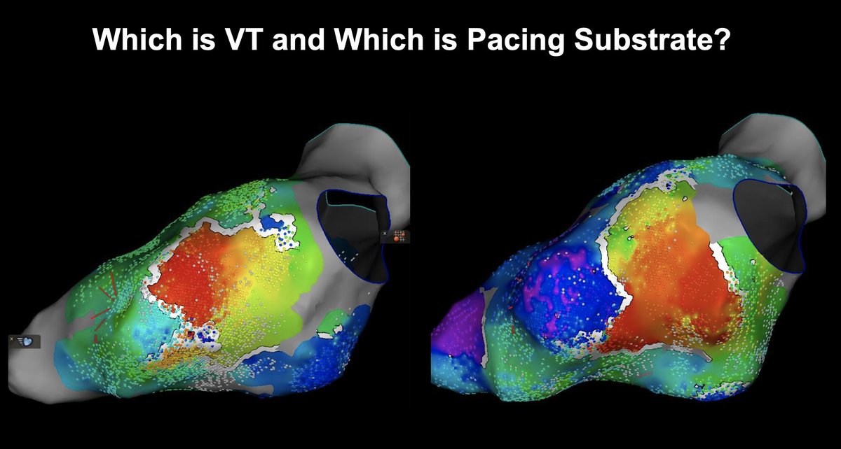 Timothy Maher, MD (@timothymahermd1) on Twitter photo Which map here is VT and which is substrate? A key to mapping fixed lines of block during VT ablation to make the WADLs best match the VT boundaries is to strategically choose a pacing site close to the presumed exit. <a href="/BIDMC_VT/">BIDMC VT Center</a> #ablateVT 1/2🧵 Which map here is VT and which is substrate? A key to mapping fixed lines of block during VT ablation to make the WADLs best match the VT boundaries is to strategically choose a pacing site close to the presumed exit. <a href="/BIDMC_VT/">BIDMC VT Center</a> #ablateVT 1/2🧵