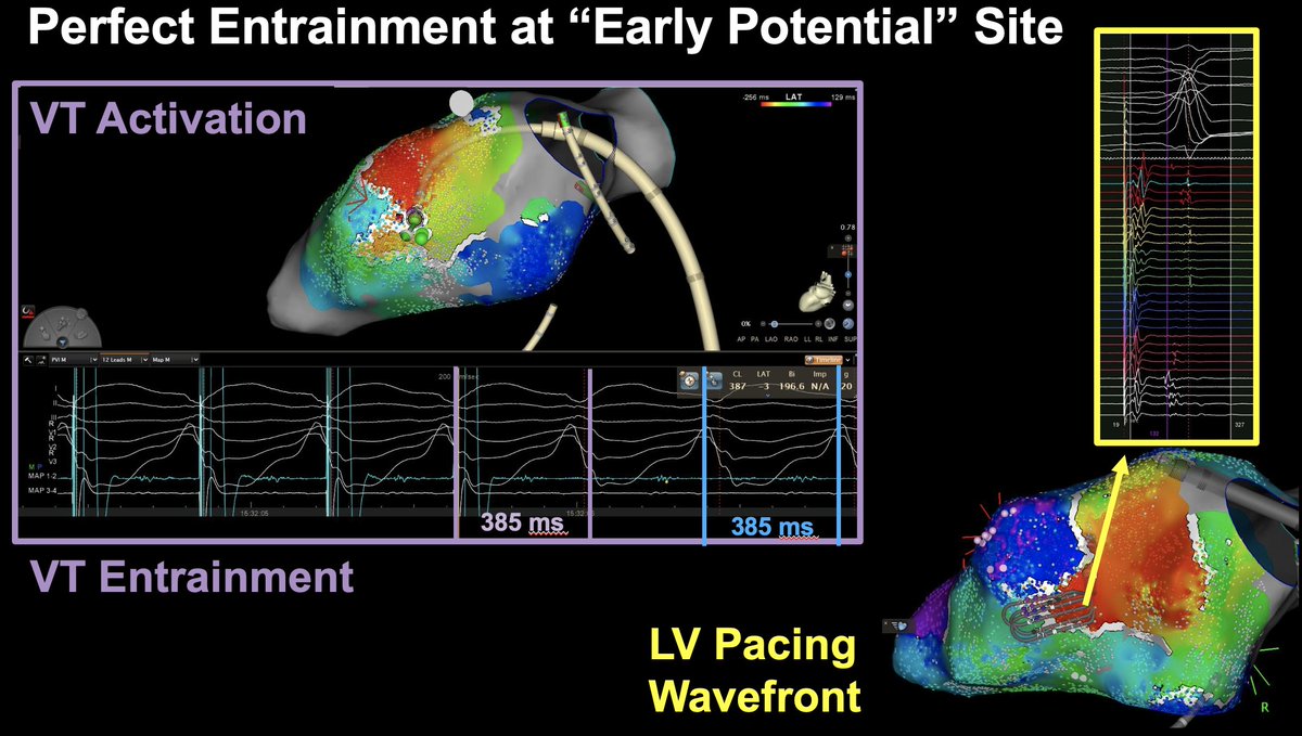 Timothy Maher, MD (@timothymahermd1) on Twitter photo This example shows how late potentials are just an interaction between the wavefront and lines of block. The best entrainment here corresponds to "early" potentials on the LV-paced map, and late potentials are outer loop in this 3D VT. <a href="/Davilandre/">Andre d’Avila</a> <a href="/DrRoderickTung/">Roderick Tung</a> <a href="/JNJMedTech/">Johnson & Johnson MedTech</a> This example shows how late potentials are just an interaction between the wavefront and lines of block. The best entrainment here corresponds to "early" potentials on the LV-paced map, and late potentials are outer loop in this 3D VT. <a href="/Davilandre/">Andre d’Avila</a> <a href="/DrRoderickTung/">Roderick Tung</a> <a href="/JNJMedTech/">Johnson & Johnson MedTech</a>