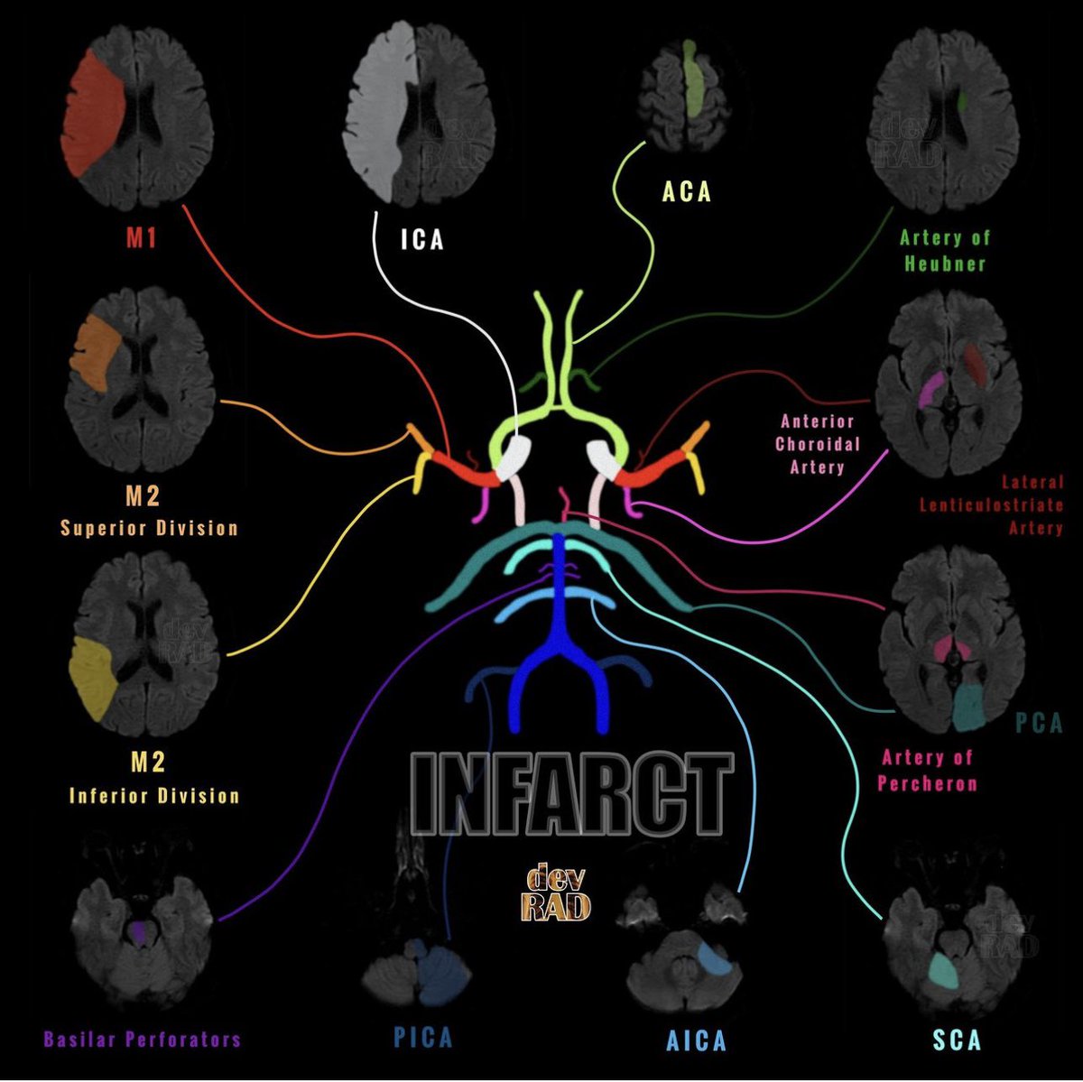 Strokes <a href="/drdevrad/">Devpriyo Pal | Radiologist</a>