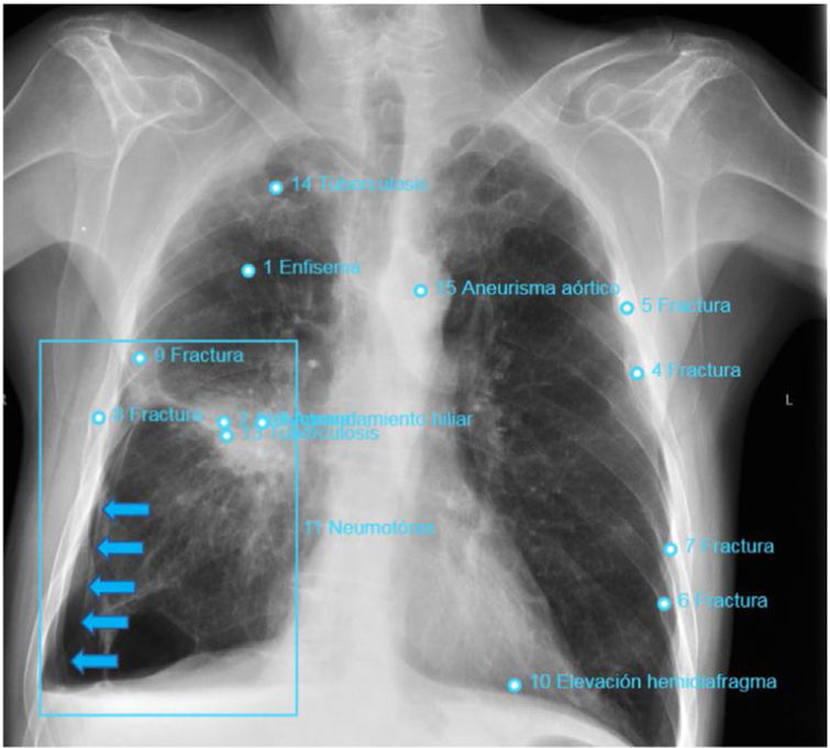 Este artículo evalúa la capacidad de detección de neumotórax por parte de un programa de inteligencia artificial en las Rx de tórax de control posbiopsia percutánea transtorácica. <a href="/SEICAT_RAD/">SEICAT</a> 
elsevier.es/es-revista-rad…
Link to the english version: elsevier.es/es-revista-rad…
