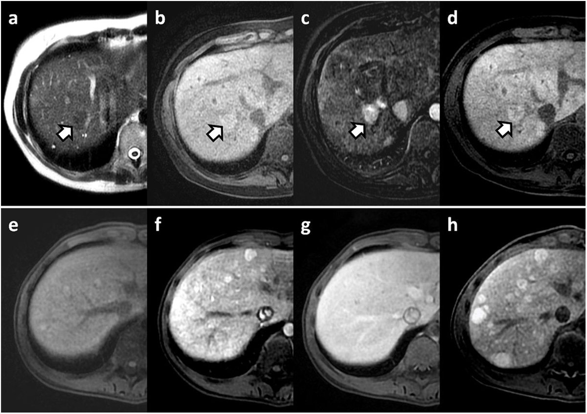 La RM hepática con contrastes hepatoespecíficos es una herramienta diagnóstica crucial para evaluar las enfermedades hepáticas <a href="/sediabdomen/">SEDIA</a> 
elsevier.es/es-revista-rad…
Link to the english version: elsevier.es/es-revista-rad…