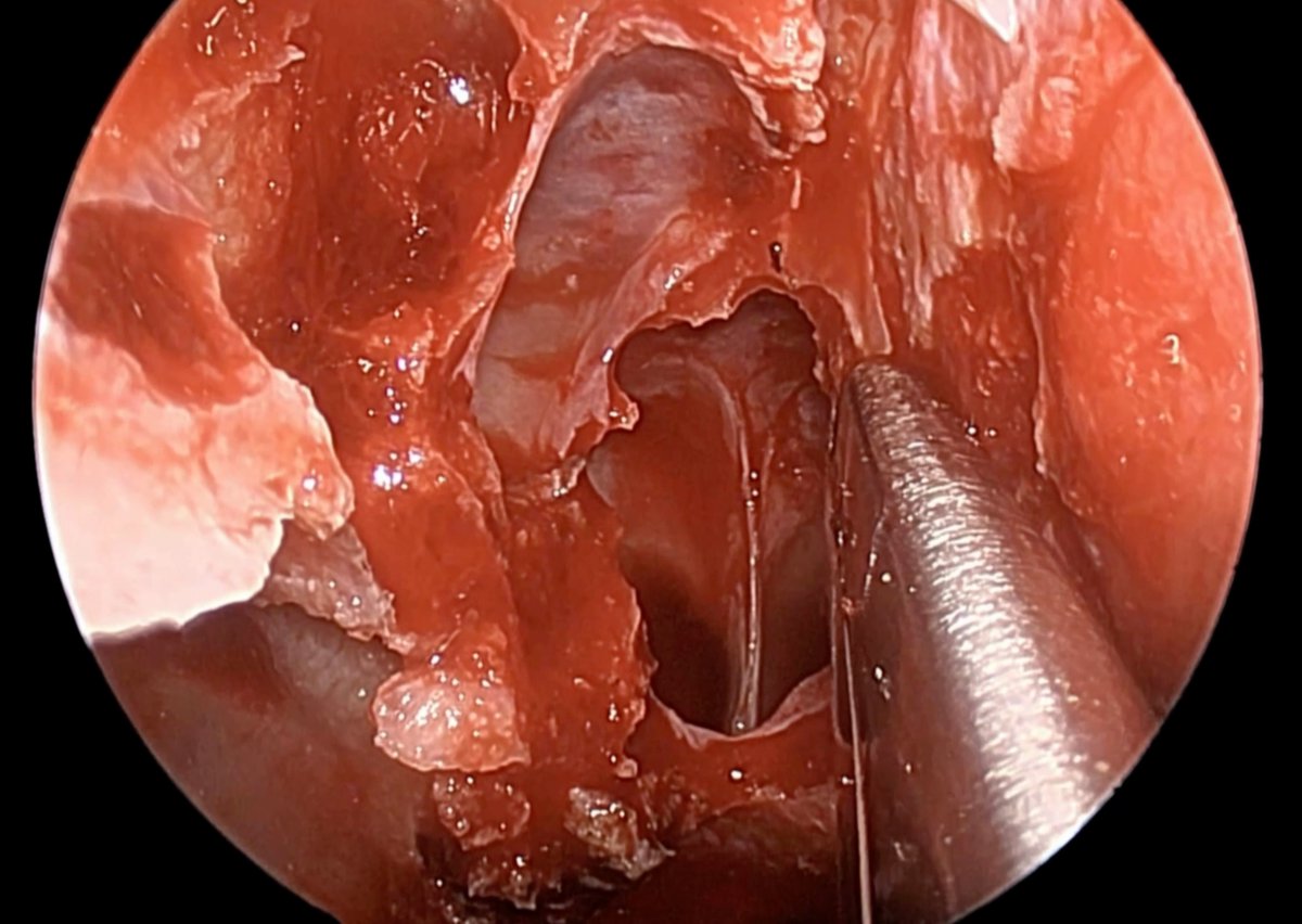Check out our <a href="/UCSF_OHNS/">UCSF Otolaryngology | Head and Neck Surgery</a> video on HPV-Associated Sinonasal Squamous Cell Carcinoma as a part of the <a href="/AHNSinfo/">AHNS</a> Skull Base Oncology Case Series! vimeo.com/1052888386