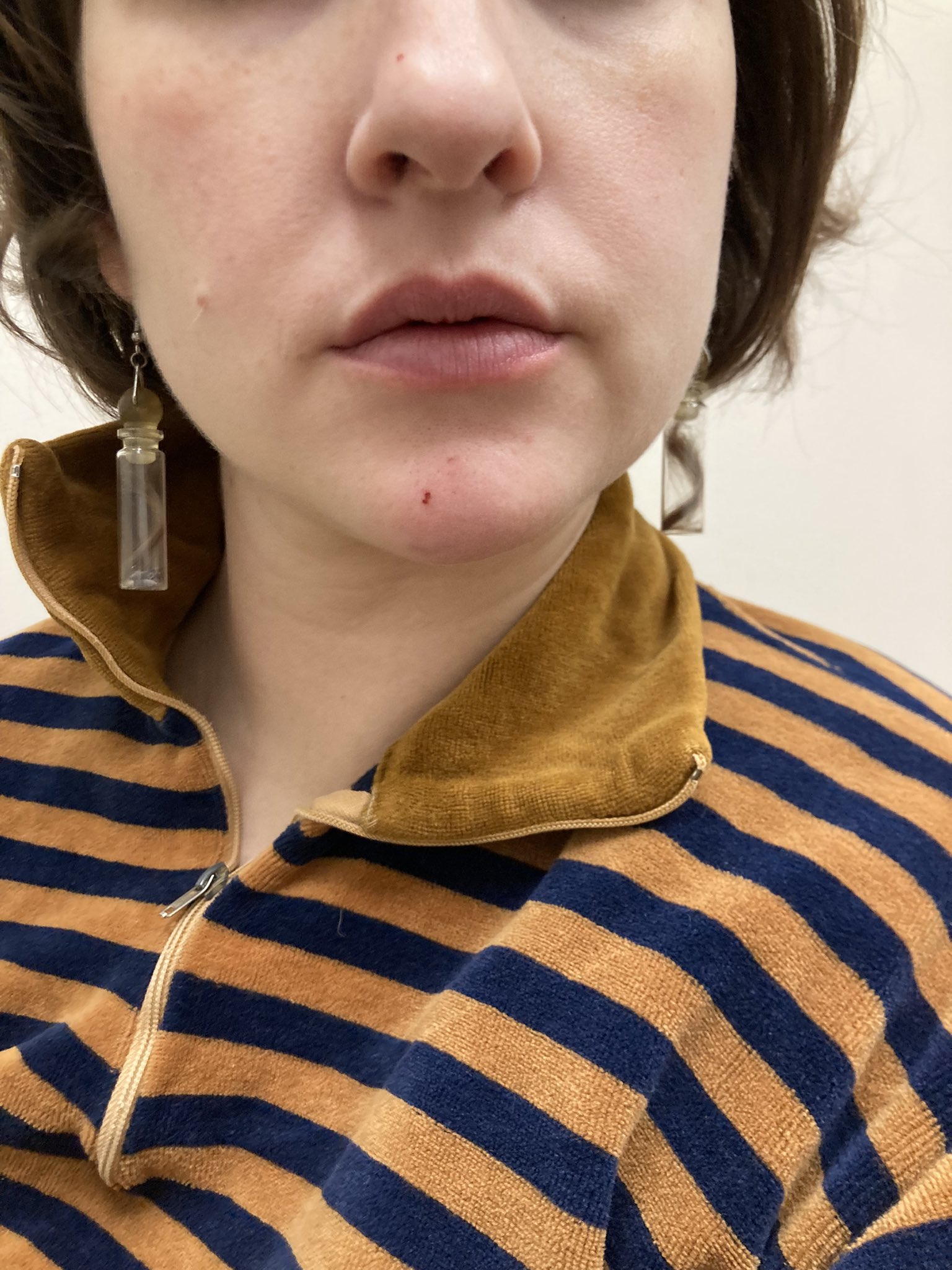 @motherpilled My relationship to these wounds is like, I have really good skin usually and I am being humbled by pure love https://t.co/Ko4xVXQSiy