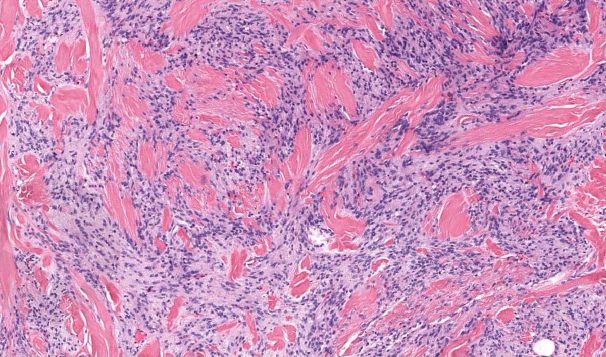 60 yo man with 2 cm breast mass. One of the BEST examples ever! 
Can you make diagnosis from one pic, or is it #TooCloseToDiagnose? 
Digital slide: kikoxp.com/posts/4600. 
Answer ✅ youtube.com/watch?v=eLmPGd… 
#pathologists #pathology #pathTwitter #BSTpath #breastpath