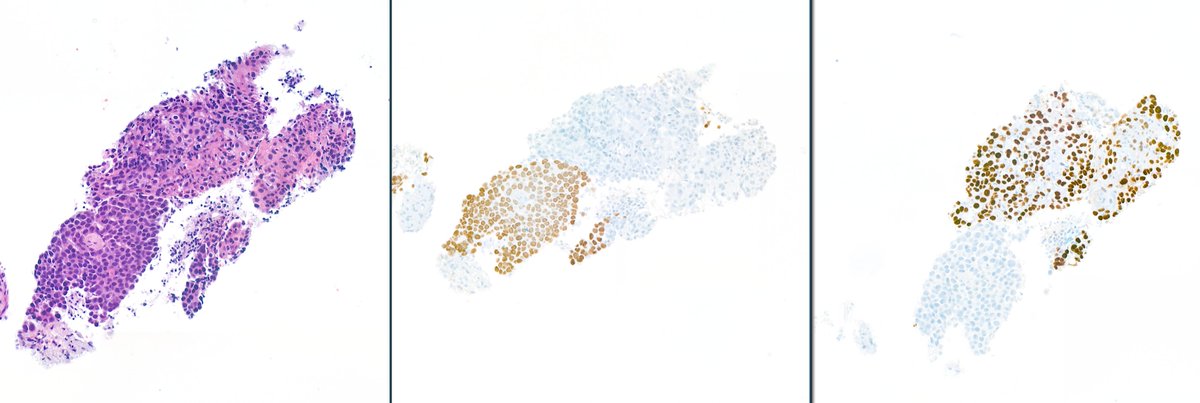 H&amp;E/TTF1/P40
Adenosquamous carcinoma not suspected on the H&amp;E #pulmpath