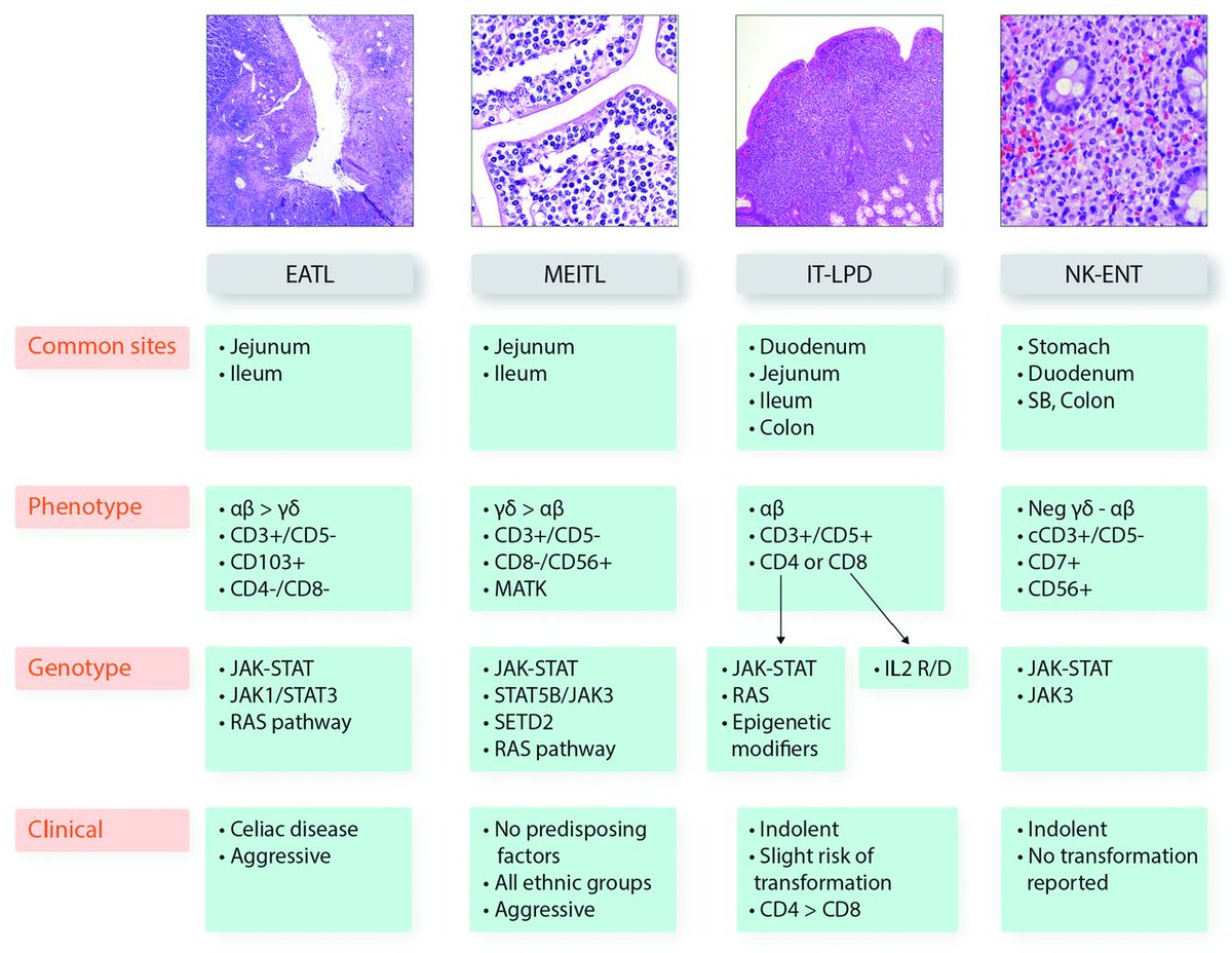 thejourneymate's tweet image. Features of Primary Intestinal T-cell and NK-cell Neoplasms

enteropathy-associated T-cell lymphoma-EATL
monomorphic epitheliotropic T-cell lymphoma-MEITL
indolent T-cell lymphoproliferative disorder-IT-LPD) 
natural killer-cell enteropathy-NK-ENT

shorturl.at/4hQEs