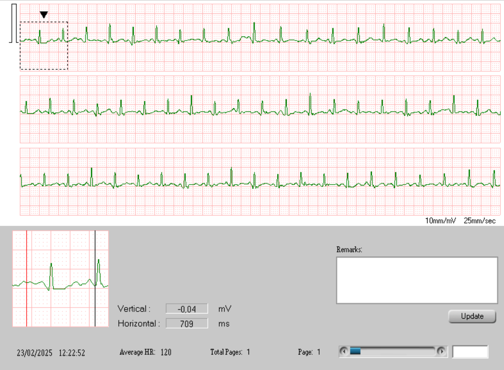 This is my resting HR after taking my meds, But the EKG looking good. Usually I get skippy, but this time it's fine.
