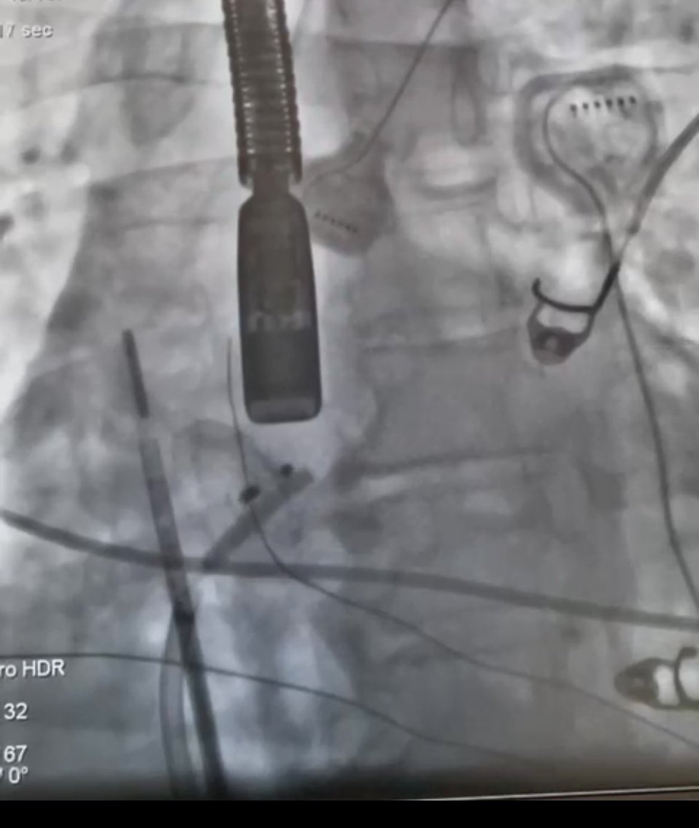 Sometimes the septum can be a tough nut to crack. #epeeps #cardiotwitter #ICEEyes #AFablation #PFOclosure #ASDclosure #amplatzer