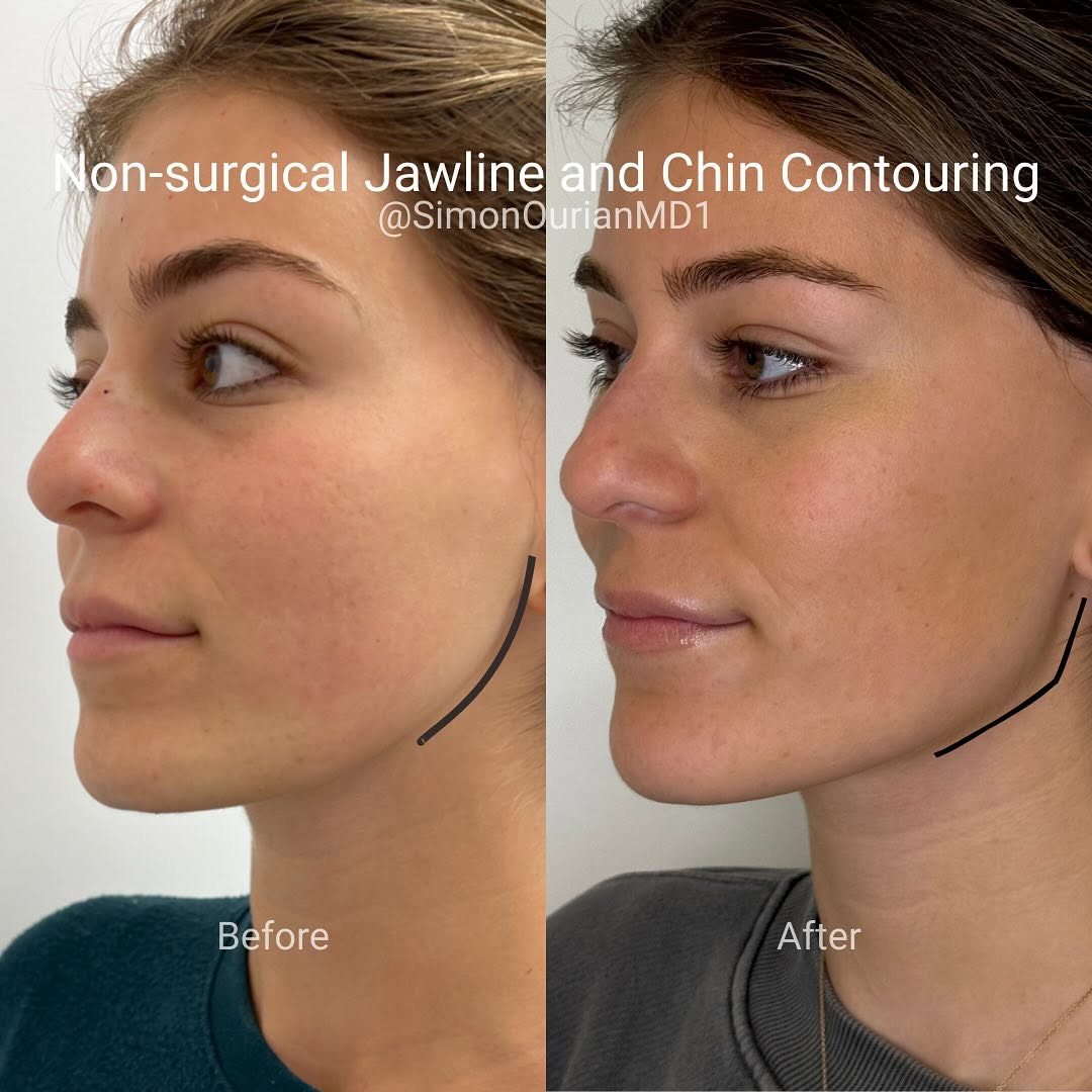simonourianmd's tweet photo. Want a snatched jawline? Visit https://t.co/iQtAoLLEW7 for your treatment options.
#jawlinecontouring #neustem #jaw #chin https://t.co/DR9VpDpMtz