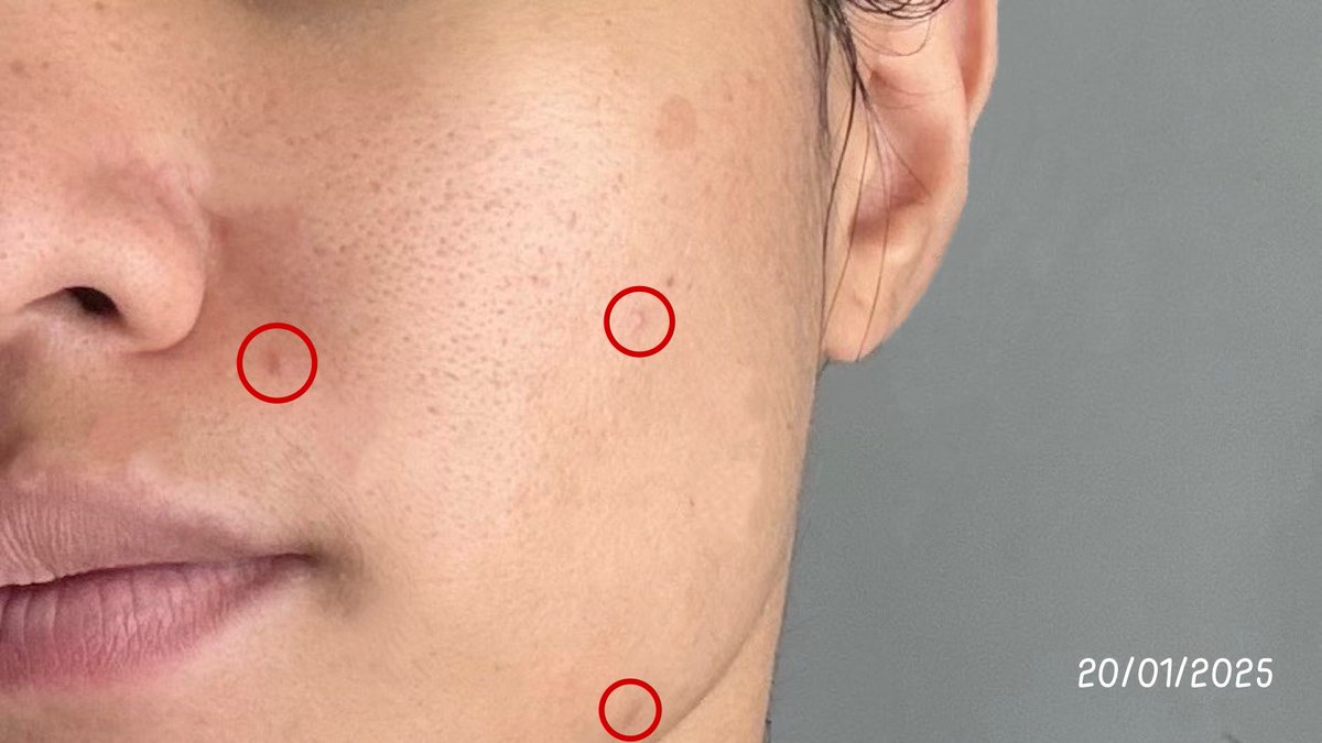 อายุเริ่มจะเข้าเลข 3 ฝ้าแดดเริ่มถามหา ไปเจอ Eucerin Booster Serum ขวดสีชมพูๆ ตัวช่วยลดฝ้าและรอยดำ ใช้ไปวีคกว่าๆ แล้วประทับมากก รอยดำจางลง ฝ้าดูเลือนๆ ผิวสม่ำเสมอขึ้น น้ามตาจะไหลลล ใช้ต่อเนื่องน่าจะค่อยๆ ผลัดผิวให้รอยลึกๆค่อยๆจางหายไป ขวดนี้ผ่าน ไปต่อแน่นอน 10/10 🫶🏼 https://t.co/7HdxFSUBJ0