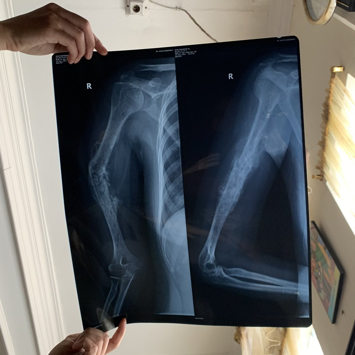 hanihanaf's tweet photo. Alhamdulillah beberapa minggu setelah kemoterapi ke 3 tangan aku mulai mengecil dan rasa sakit kanker nya mulai berkurang tapi kondisi tulang tangan aku menjadi bengkok https://t.co/6a0eJ78Vn0