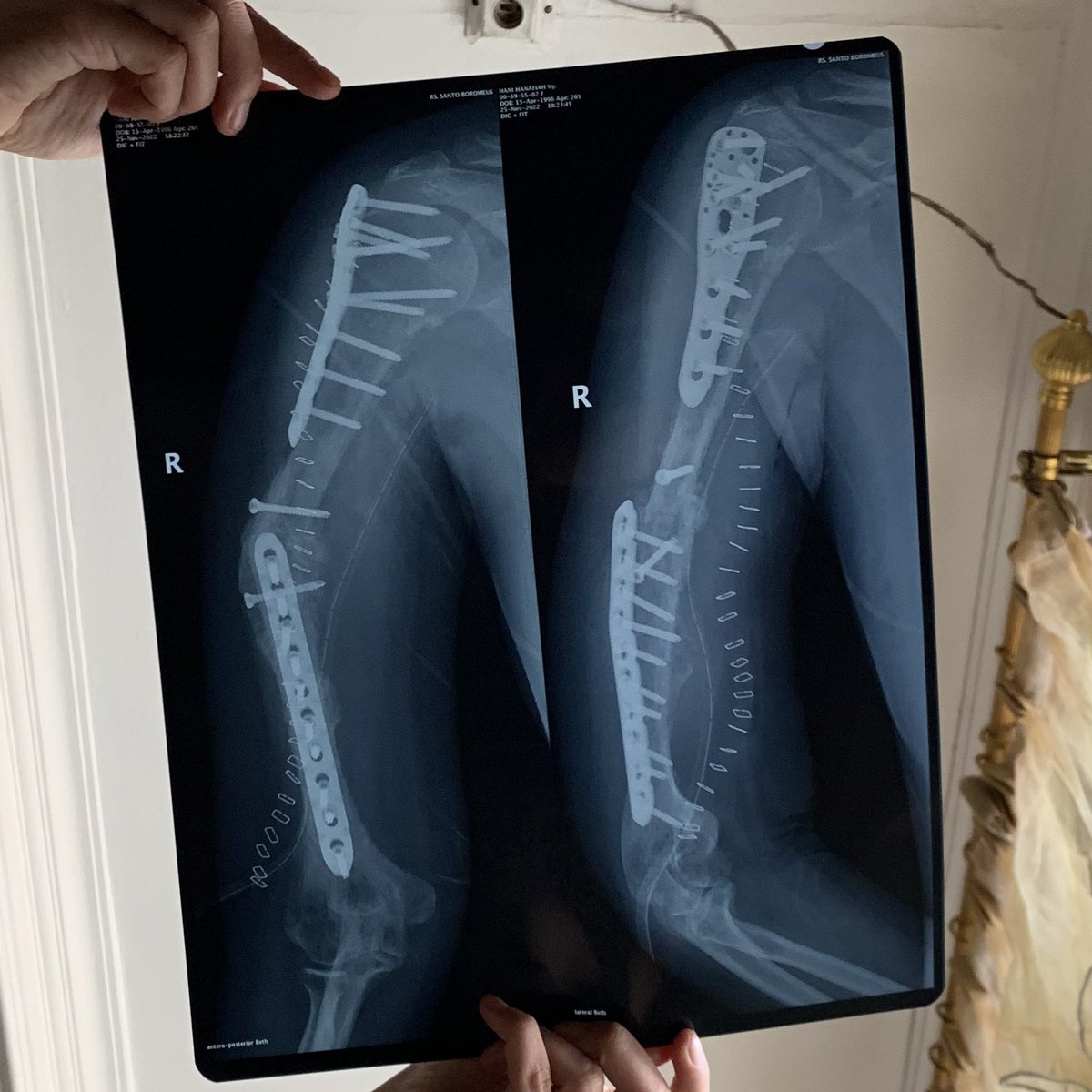 hanihanaf's tweet photo. Operasi kanker tulang aku itu prosesnya seperti ini, tulang nya di potong di keluarkan dari tangan, dibersihkan dari kankernya, lalu tulang aku masih bisa dipertahankan jadi dimasukan lagi (November 2022) mulai sejak ini senyumku kembali merekah karna sakit kanker sudah tidak ada https://t.co/tUwuxhWQR9