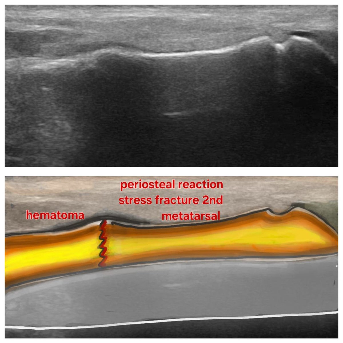 Stress fracture in second metatarsal