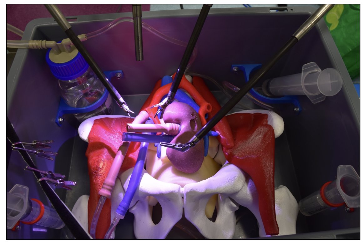 Riccardo Campi (@ric_campi) on Twitter photo I am really proud to see that the #RAKT Box is being implemented at <a href="/orsiacademy/">Orsi Academy</a> and will help training in vascular anastomoses during the <a href="/ERUSrobotics/">ERUS Robotic Urology</a> #RAKT course (pubmed.ncbi.nlm.nih.gov/38554210/)
It was a long but rewarding #PhD journey <a href="/AOUCareggi/">Azienda Ospedaliero-Universitaria Careggi</a> <a href="/UNI_FIRENZE/">Università di Firenze</a>
Thanks to <a href="/Medics3D/">Medics</a> I am really proud to see that the #RAKT Box is being implemented at <a href="/orsiacademy/">Orsi Academy</a> and will help training in vascular anastomoses during the <a href="/ERUSrobotics/">ERUS Robotic Urology</a> #RAKT course (pubmed.ncbi.nlm.nih.gov/38554210/)
It was a long but rewarding #PhD journey <a href="/AOUCareggi/">Azienda Ospedaliero-Universitaria Careggi</a> <a href="/UNI_FIRENZE/">Università di Firenze</a>
Thanks to <a href="/Medics3D/">Medics</a>