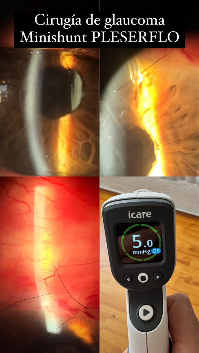 PRESERFLO MINISHUNT FOR GLAUCOMA