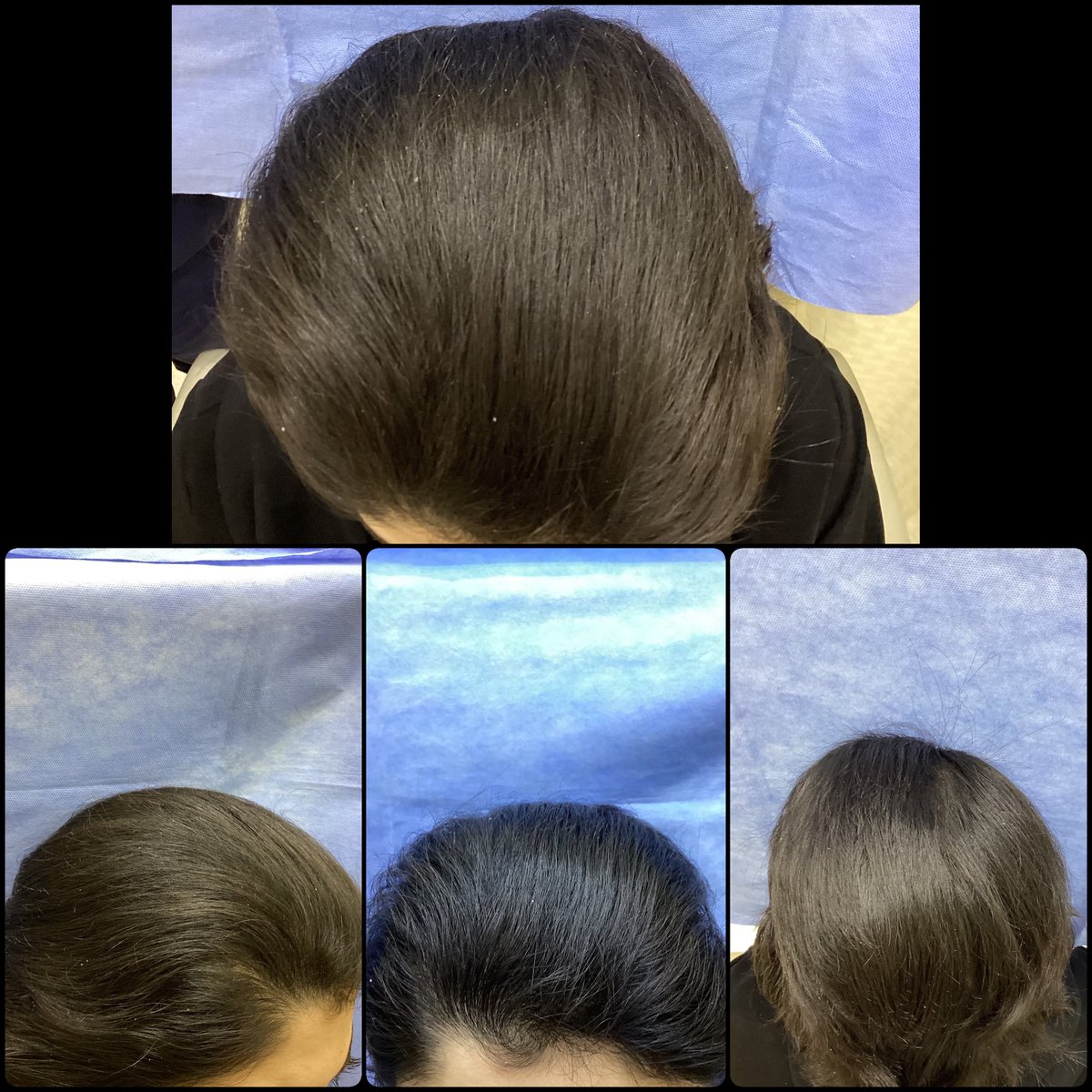 قبل وبعد عملية #زراعة_الشعر بـ ٦ أشهر للنساء

نتيجة ممتازة 👏
تختلف طبيعة توزيع البصيلات للنساء بشكل كبير عن الرجال
من المهم اختيار مركز وطبيب متخصص والحرص على المتابعة الطبية