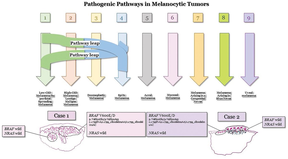 AJDP_Journal's tweet photo. #WhatsNewInDermpath

“Pathway leap”: a new molecular phenomenon to consider in the pathogenesis of melanocytic tumors
- melanocytic tumors of a specific pathway may “leap” to another pathway through a mutational process.

Full article link: https://t.co/1zlGMQHYOL https://t.co/K1D6wGjioL