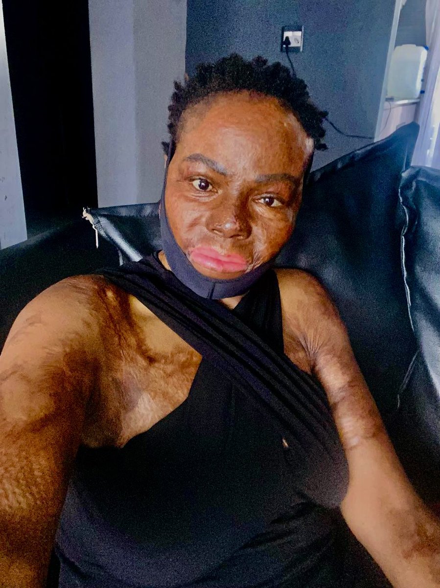 As much healed my skin can look
I still have conditions that I have learned to live with 

Like my lipless mouth… food drips when eating 
I don’t eat in public 

My lobeless ear that has fluid dripping that needs drainage 

Because I have survived I turn to forget about those
