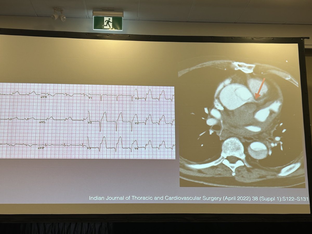 David Carr (@davidcarr333) on Twitter photo <a href="/CREEurope/">Jeff Jaskolka</a> nothing like learning EKGs from a radiologist. Love it. Making scary diagnoses so simple. <a href="/CREEurope/">Jeff Jaskolka</a> nothing like learning EKGs from a radiologist. Love it. Making scary diagnoses so simple.
