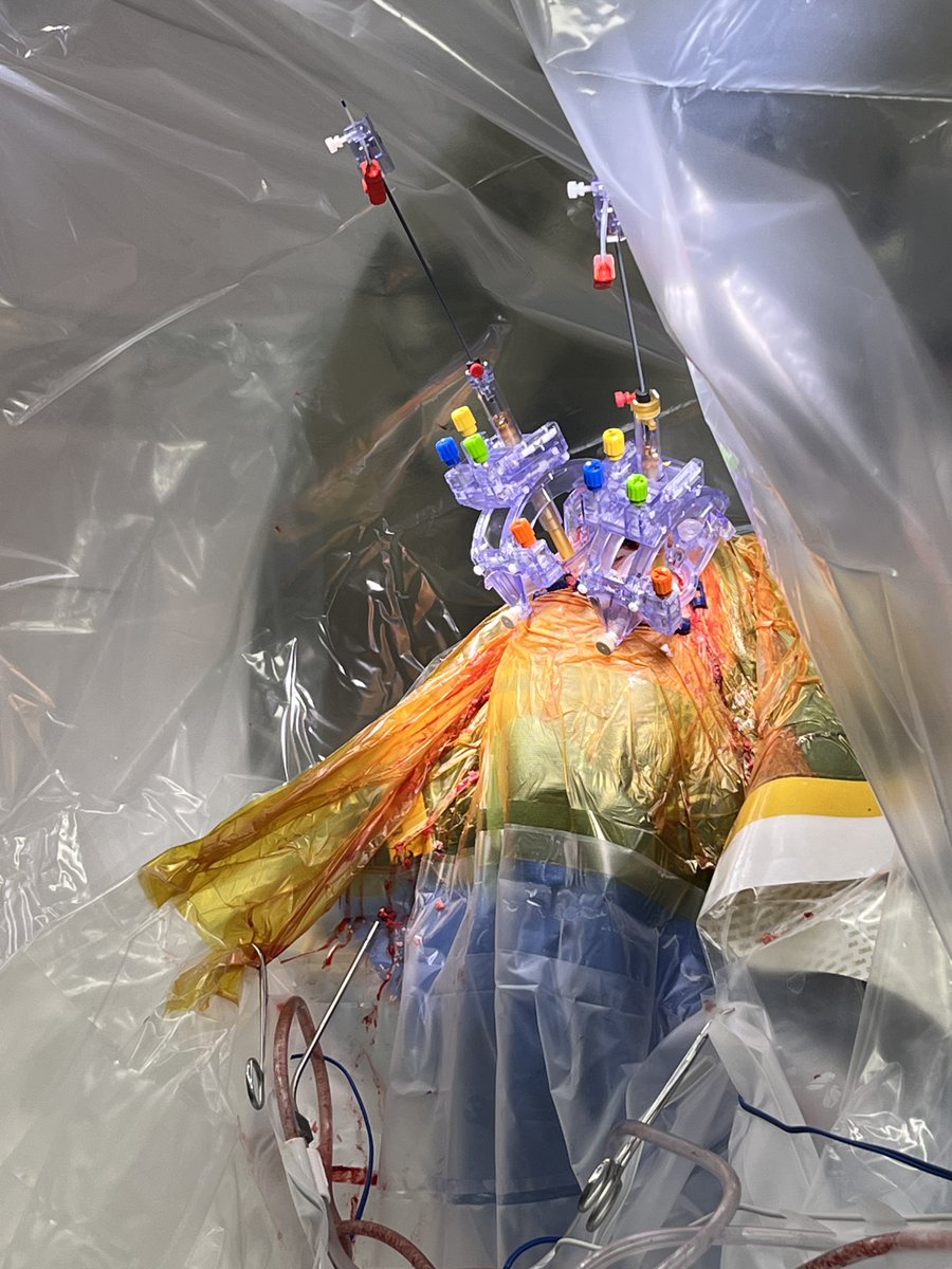 Henry Ford Neuroscience (@henryfordneuro) on Twitter photo Congratulations to <a href="/nsurgchick/">Ellen Air</a> and her team on successfully completing the first two <a href="/ClearPointNeuro/">ClearPointNeuro</a> CT-guided procedures! Both cases went smoothly, providing our patients with another valuable option for DBS. Incredible work! 🎉 <a href="/HenryFordHealth/">Henry Ford Health</a> #DBS #Innovation Congratulations to <a href="/nsurgchick/">Ellen Air</a> and her team on successfully completing the first two <a href="/ClearPointNeuro/">ClearPointNeuro</a> CT-guided procedures! Both cases went smoothly, providing our patients with another valuable option for DBS. Incredible work! 🎉 <a href="/HenryFordHealth/">Henry Ford Health</a> #DBS #Innovation