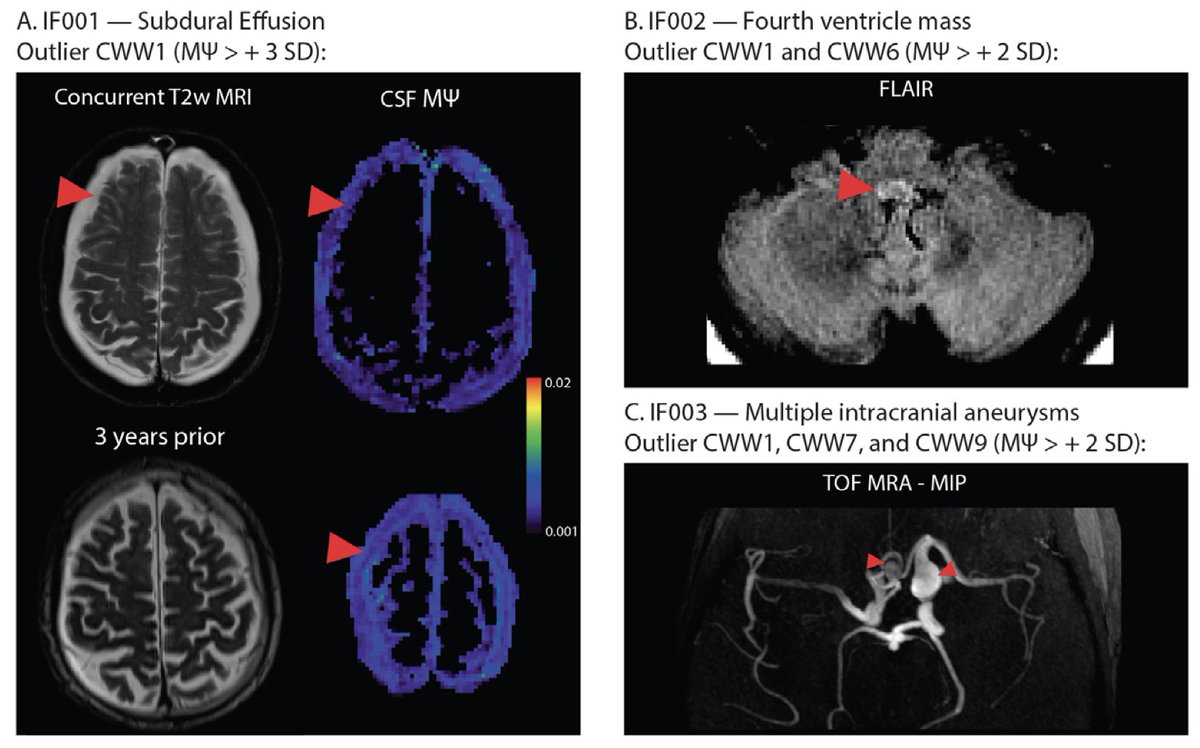 New paper in Imaging Neuroscience by Arash Nazeri, Aristeidis Sotiras, et al:

Characterizing the spatial patterns and determinants of cerebrospinal fluid pseudorandom flow in the human brain with low b-value diffusion MRI

doi.org/10.1162/imag_a…