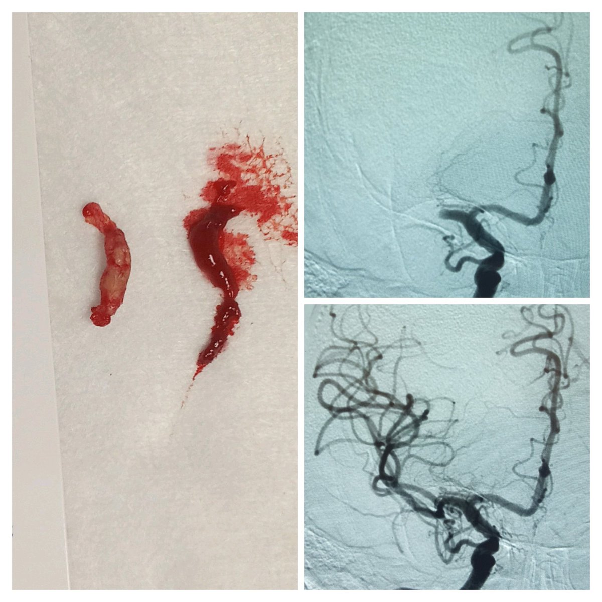 Midnight thrombectomy. Patient with endocarditis. TICI 3.  

Done by our good fellow Dr Zahra Bahrami. Seems the white embolus was leading and red one followed.