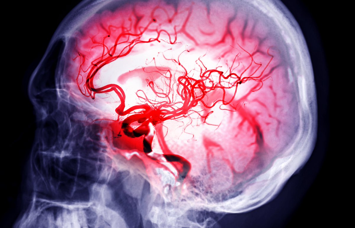 Sydney Health (@syd_health) on Twitter photo Can a stroke change the experience of sexuality among LGBTQIA+ stroke survivors and their partners?
<a href="/Sydney_Uni/">University of Sydney</a> #health #sciences PhD candidate Will Kokay led a recently published study to start the conversation.
Find out more: tandfonline.com/doi/full/10.10… Can a stroke change the experience of sexuality among LGBTQIA+ stroke survivors and their partners?
<a href="/Sydney_Uni/">University of Sydney</a> #health #sciences PhD candidate Will Kokay led a recently published study to start the conversation.
Find out more: tandfonline.com/doi/full/10.10…