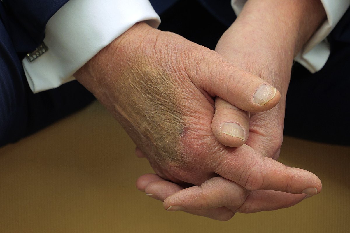 Scrolling Getty and couldn't help but notice this photo of a huge bruise on Trump's hand today