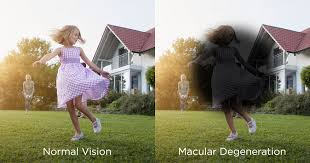 SeeFisch's tweet photo. Dear @elonmusk Dear @SecKennedy please help drive down these costs.
10% above age 50 have macular degeneration
1,500,000 Americans have LATE STAGE macular degeneration
C3 inhibitor Pegcetacoplan: $25,000 a year
C5 inhibitor Avacincaptad: $25,000 a year https://t.co/NwOVZspd14