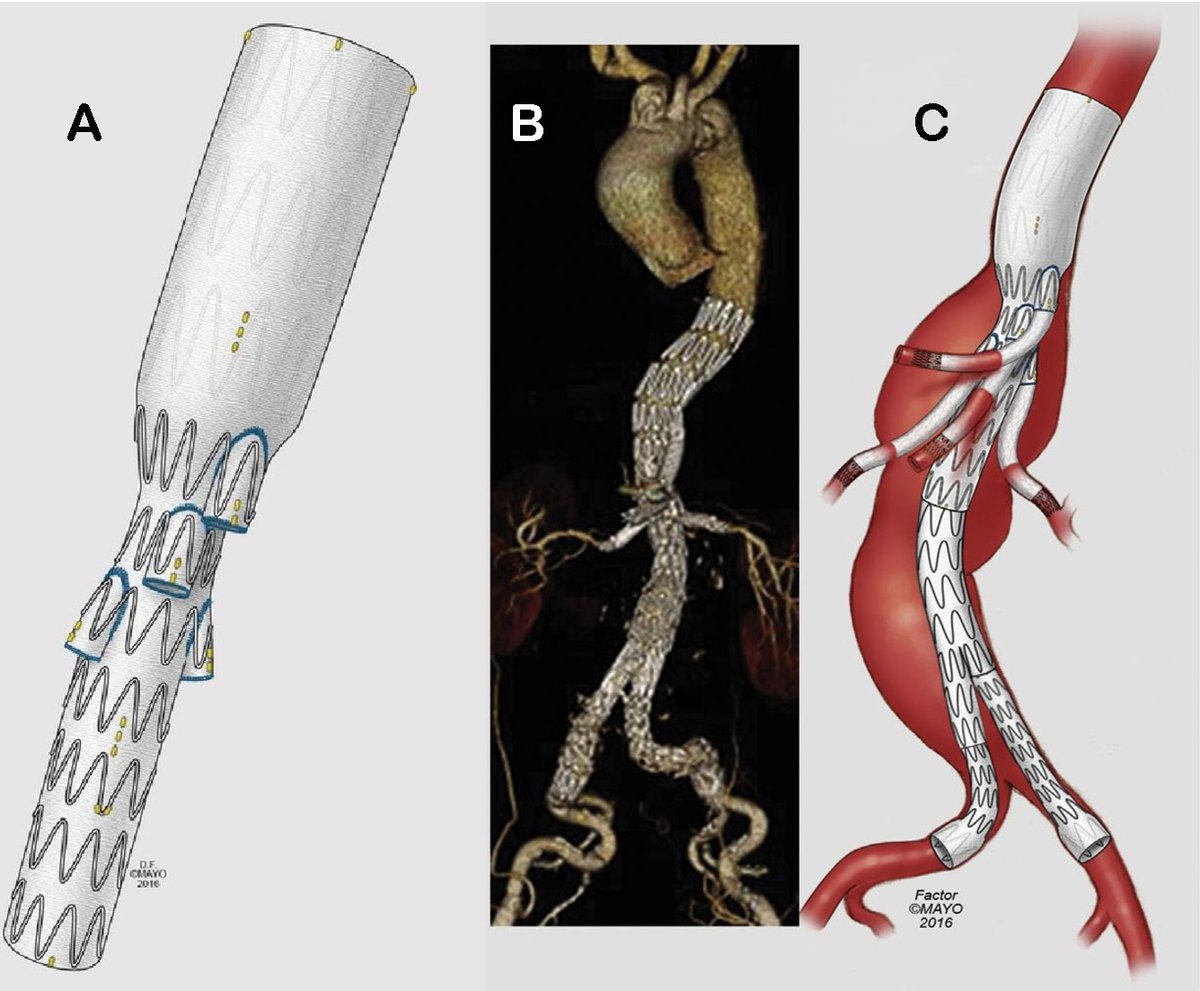 Vessel_Plus's tweet photo. 🚀Excited to share a curated collection of 10 high-impact articles published in 23 &amp; 24
📌2024
1.Current state of endovascular repair of thoracoabdominal aortic aneurysms
https://t.co/D4FNbfE3TX
2.Role of inflammation in the progression of diabetic disease
https://t.co/pFHxDRtLsJ https://t.co/sGRntr31ay