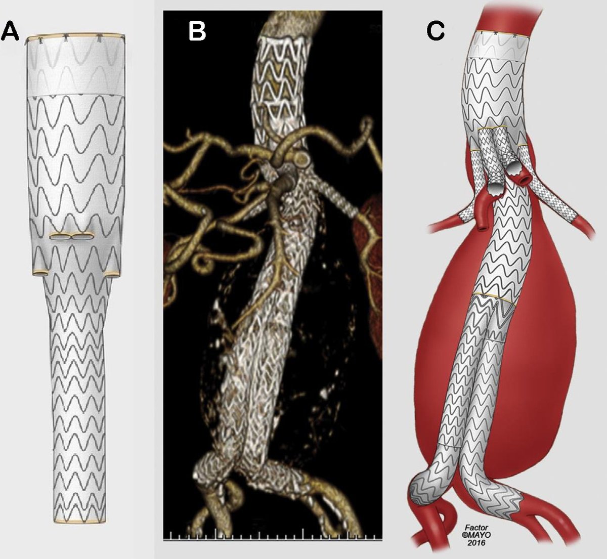 Vessel_Plus's tweet photo. 🚀Excited to share a curated collection of 10 high-impact articles published in 23 &amp; 24
📌2024
1.Current state of endovascular repair of thoracoabdominal aortic aneurysms
https://t.co/D4FNbfE3TX
2.Role of inflammation in the progression of diabetic disease
https://t.co/pFHxDRtLsJ https://t.co/sGRntr31ay