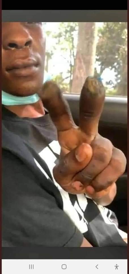 NupQuin's tweet image. His fingers were cut off by his abductors for being a member of the @NUP_Ug..!!
#StopAbductionsUG