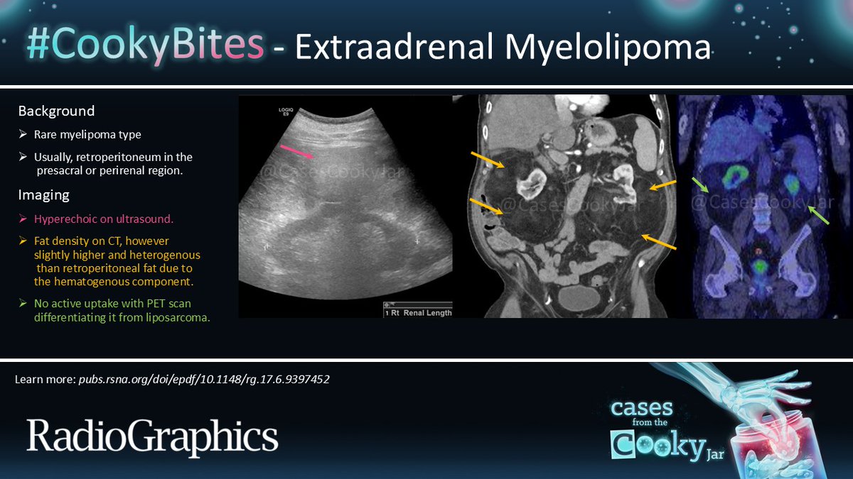 Cases From the Cooky Jar (@casescookyjar) on Twitter photo Answer: Extraadrenal Myelolipoma
Learn more: 🔗pubs.rsna.org/doi/epdf/10.11…
#CookyBites #204 #RGphx <a href="/cookyscan1/">Cooky Menias</a> <a href="/RadioGraphics/">RadioGraphics</a> Answer: Extraadrenal Myelolipoma
Learn more: 🔗pubs.rsna.org/doi/epdf/10.11…
#CookyBites #204 #RGphx <a href="/cookyscan1/">Cooky Menias</a> <a href="/RadioGraphics/">RadioGraphics</a>