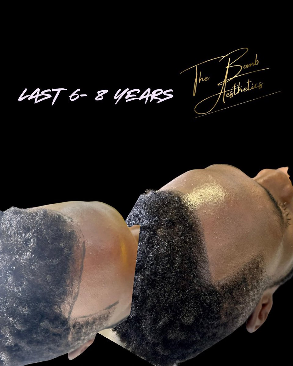 BombAesthetics's tweet photo. - Immediate Hairline Restoration ✨
- Long-lasting Results (6-8 Years) ⏳
- Non-Invasive &amp; Safe 🛡data:️
- Boosts Confidence 💪
- Natural-Looking Solution 👌 https://t.co/1yz1iPvgyu