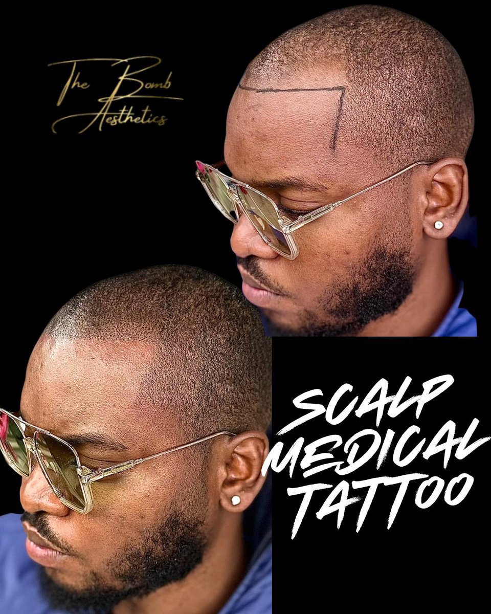 BombAesthetics's tweet photo. - Immediate Hairline Restoration ✨
- Long-lasting Results (6-8 Years) ⏳
- Non-Invasive &amp; Safe 🛡data:️
- Boosts Confidence 💪
- Natural-Looking Solution 👌 https://t.co/1yz1iPvgyu