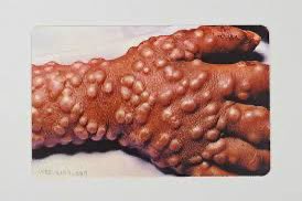 Smallpox would still be here if not for vaccines