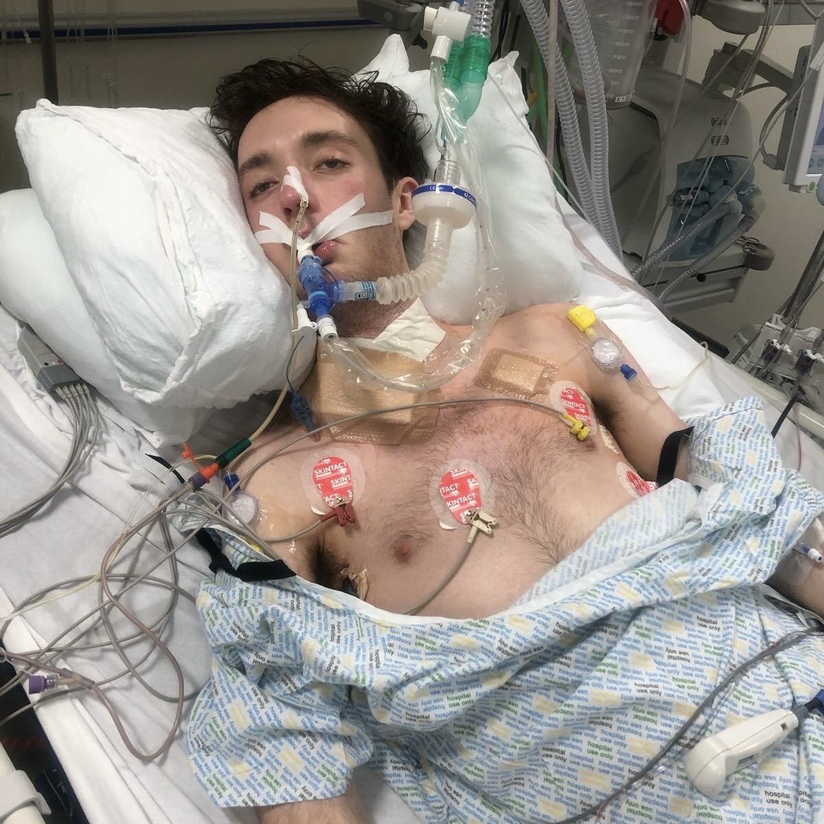 TheBDA's tweet image. A stark reminder that access to dentistry can be a life or death issue.

Nick Whelan ended up in ICU with dental sepsis &amp;amp; now lives with permanent scars.

Hospital dentists have seen a spike in cases

It’s not enough to call it &apos;Dickensian&apos; – we need action to stop this UK-wide.