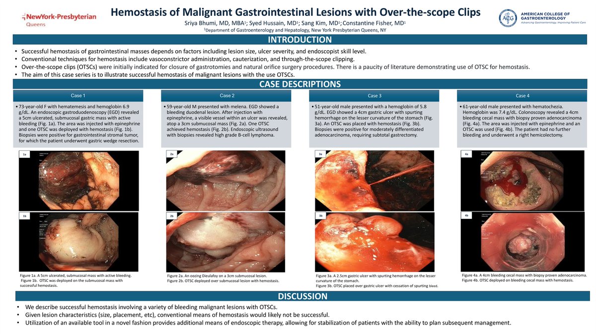 STERIS Endoscopy (@sterisendoscopy) on Twitter photo A new study demonstrates the PADLOCK CLIP™ Defect Closure System achieving successful hemostasis in various malignant gastrointestinal lesions: hubs.la/Q03762FH0
Congratulations to Dr. Constantine Fisher, Dr. Sriya Bhumi, Dr. Syed Hussain, and Dr. Sang Hoon Kim on A new study demonstrates the PADLOCK CLIP™ Defect Closure System achieving successful hemostasis in various malignant gastrointestinal lesions: hubs.la/Q03762FH0
Congratulations to Dr. Constantine Fisher, Dr. Sriya Bhumi, Dr. Syed Hussain, and Dr. Sang Hoon Kim on