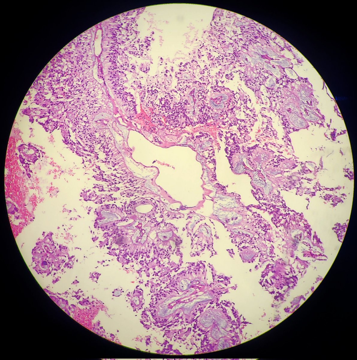SyedSal55391459's tweet image. #histopathology
#tumor
#spinalcord
#pathX
#pathTwitter
#cellphonephotograph
Dx: Myxopapillary epedymoma.