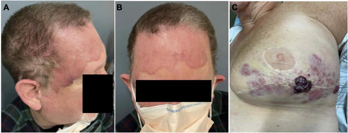 ACS Journal Cancer tweet media