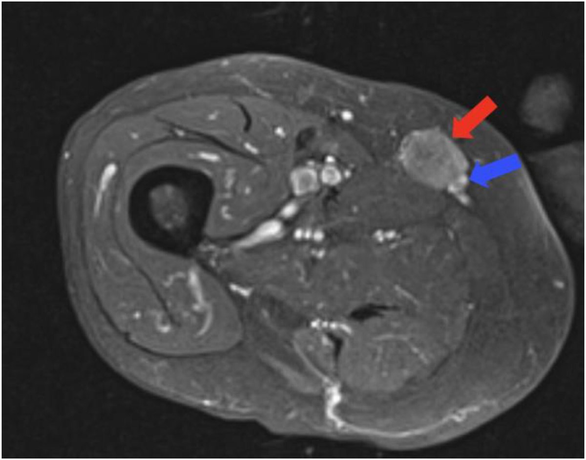 ACS Journal Cancer (@journalcancer) on Twitter photo New review article led by <a href="/AmyWisdom8/">Amy Wisdom, MD, PhD</a> of @harvardradonc | Clinician's primer for soft tissue sarcomas: Nuances of histologic subtypes
acsjournals.onlinelibrary.wiley.com/doi/10.1002/cn…
<a href="/OncoAlert/">OncoAlert</a> <a href="/chandrajitraut/">Chandrajit Raut</a> <a href="/candace_haddox/">Candace Haddox, MD</a> <a href="/JLHornick/">Jason L. Hornick, M.D., Ph.D.</a> <a href="/corrie_painter/">Dear Dr. Researcher, PhD</a> New review article led by <a href="/AmyWisdom8/">Amy Wisdom, MD, PhD</a> of @harvardradonc | Clinician's primer for soft tissue sarcomas: Nuances of histologic subtypes
acsjournals.onlinelibrary.wiley.com/doi/10.1002/cn…
<a href="/OncoAlert/">OncoAlert</a> <a href="/chandrajitraut/">Chandrajit Raut</a> <a href="/candace_haddox/">Candace Haddox, MD</a> <a href="/JLHornick/">Jason L. Hornick, M.D., Ph.D.</a> <a href="/corrie_painter/">Dear Dr. Researcher, PhD</a>