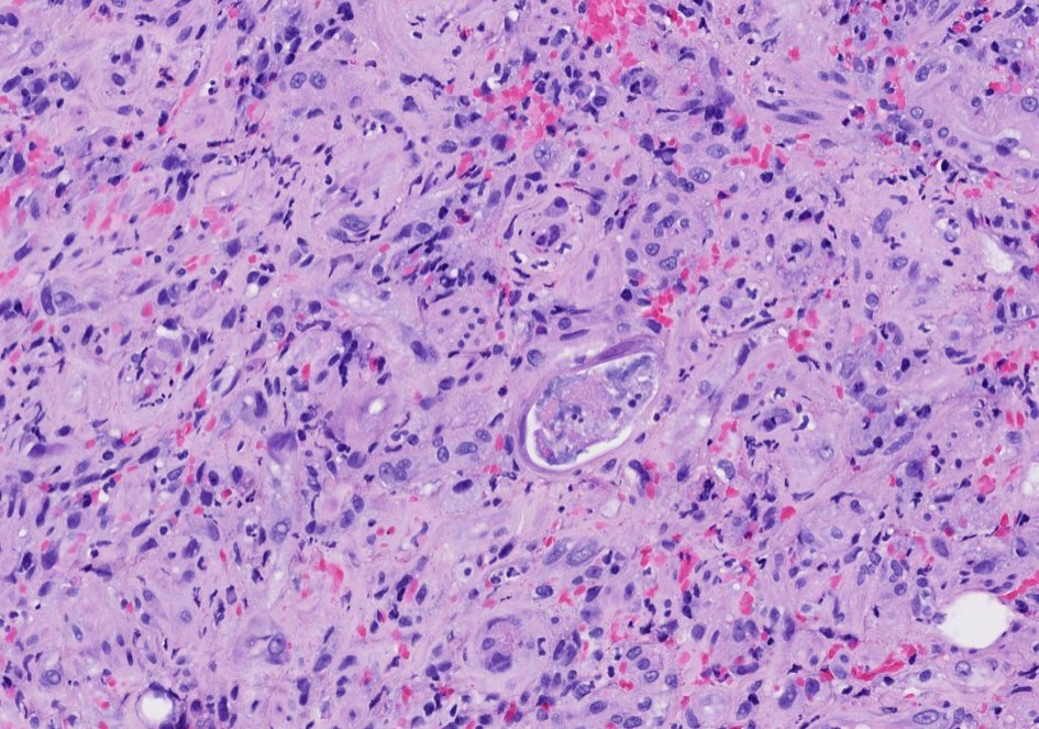 Non-neoplastic gastric pathology problems
57 yo M with a gastric ulcer and history of liver transplant
Malignant...or maybe not?

Final diagnosis: 90Y-TheraSpheres associated gastric ulcer

Clues for diagnosis
-Therasphere beads (mimic air-bubble artifact) against a background of